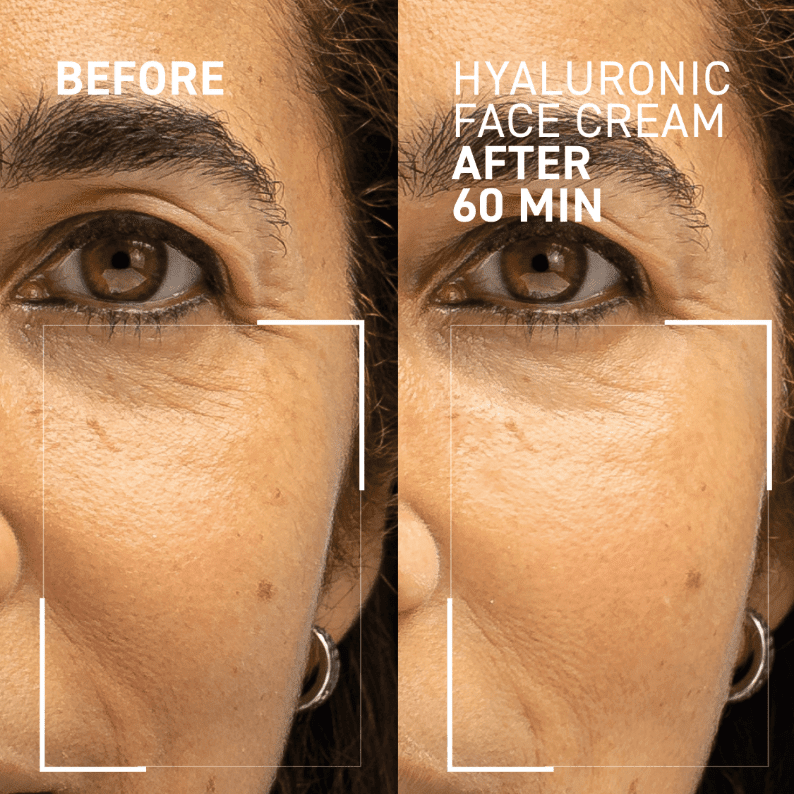 How Hyaluronic Acid Cream Can Improve The Appearance Of Fine Lines