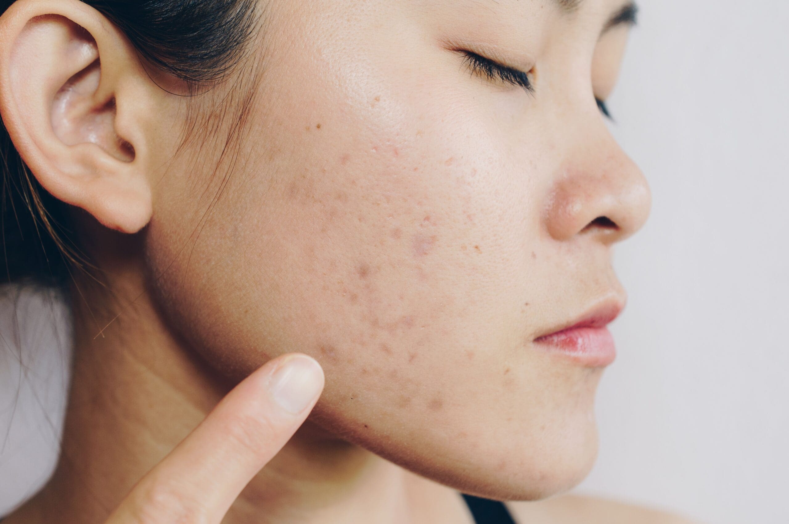 The Pros And Cons Of Using Hyaluronic Acid Cream For Acne-Prone Skin